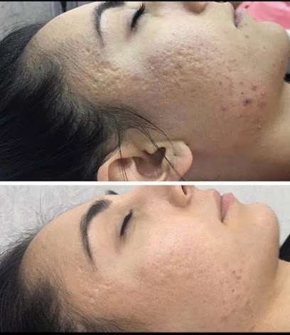 LED THÉRAPIE ET MICRONEEDLING, Institut de Beauté à Vincennes